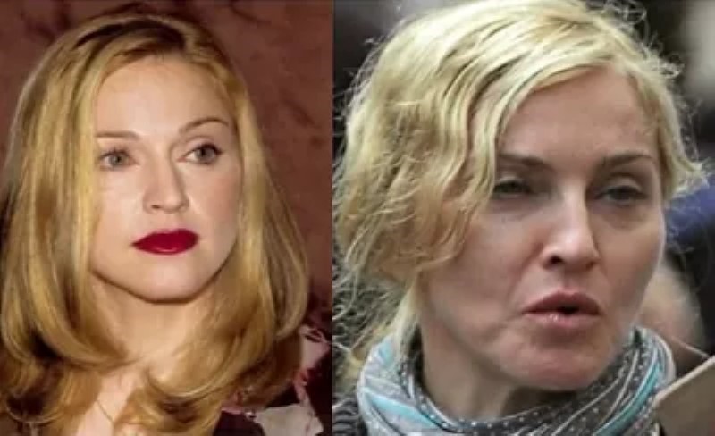 Famous women who overdid it with botox and this is how their faces looked like