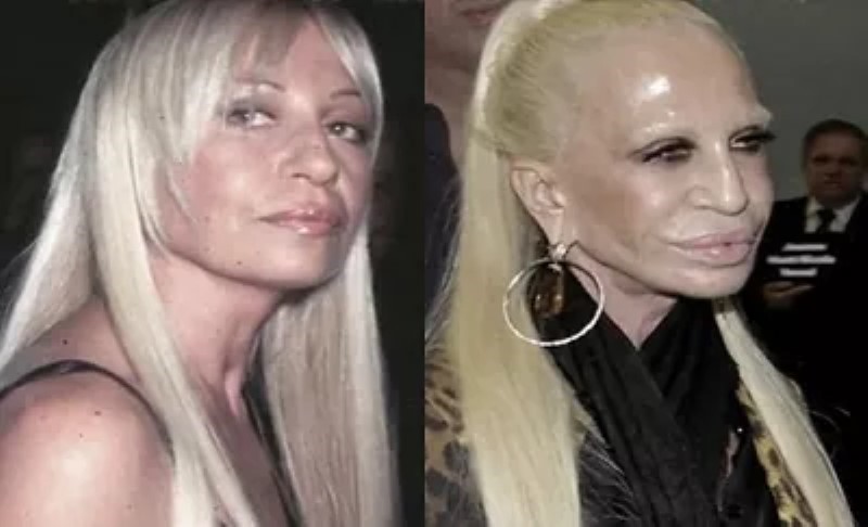 Famous women who overdid it with botox and this is how their faces looked like